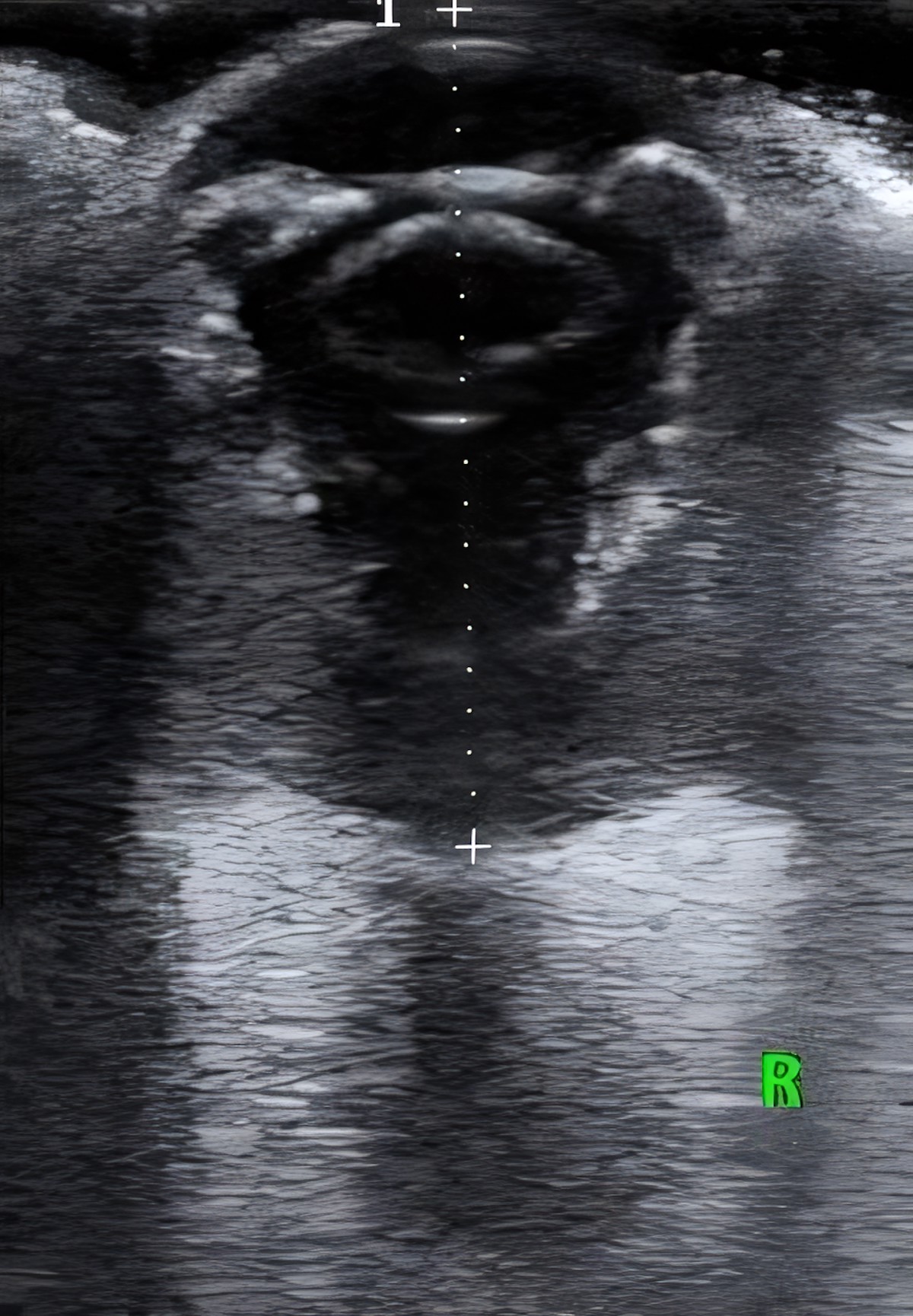 retinaleválás és nuclearis sclerosis